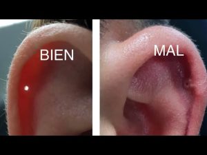 Como curar un piercing infectado en la oreja