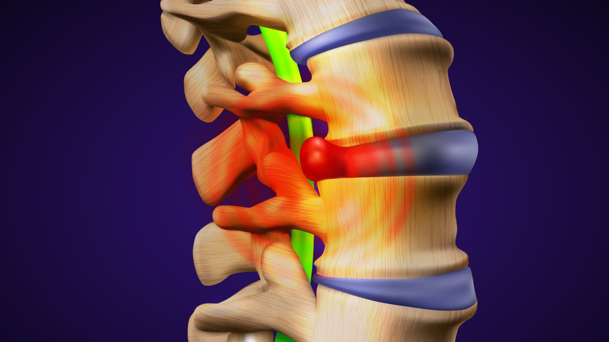Factores de riesgo para desarrollar una hernia discal
