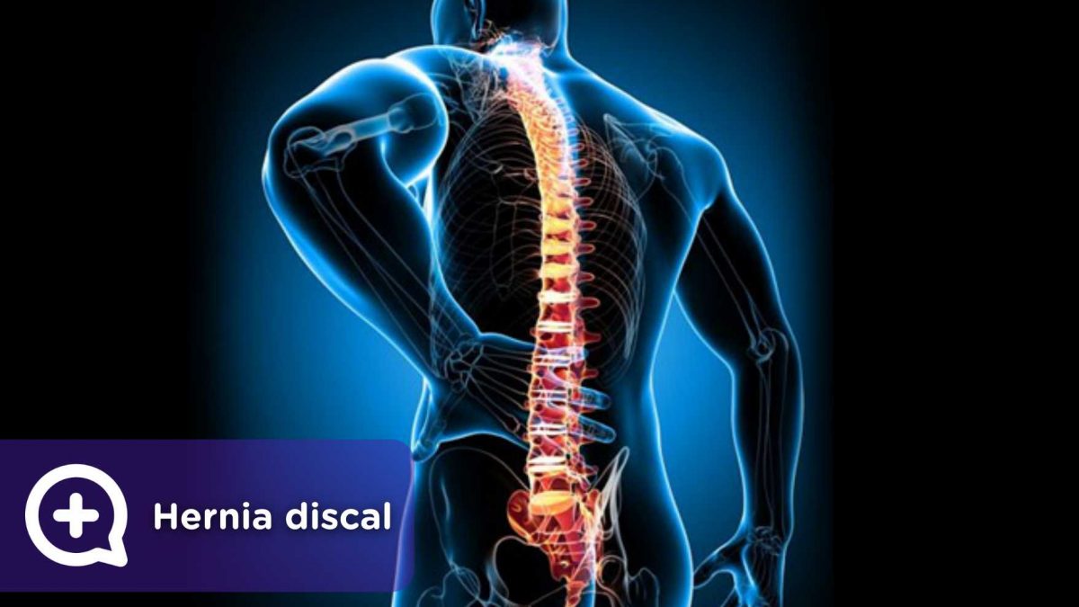 Síntomas comunes de una hernia discal